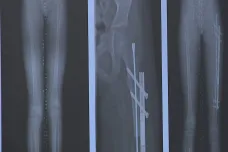 V brněnské dětské nemocnici začali pacientům prodlužovat kosti pomocí magnetického hřebu