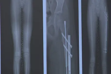 V brněnské dětské nemocnici začali pacientům prodlužovat kosti pomocí magnetického hřebu