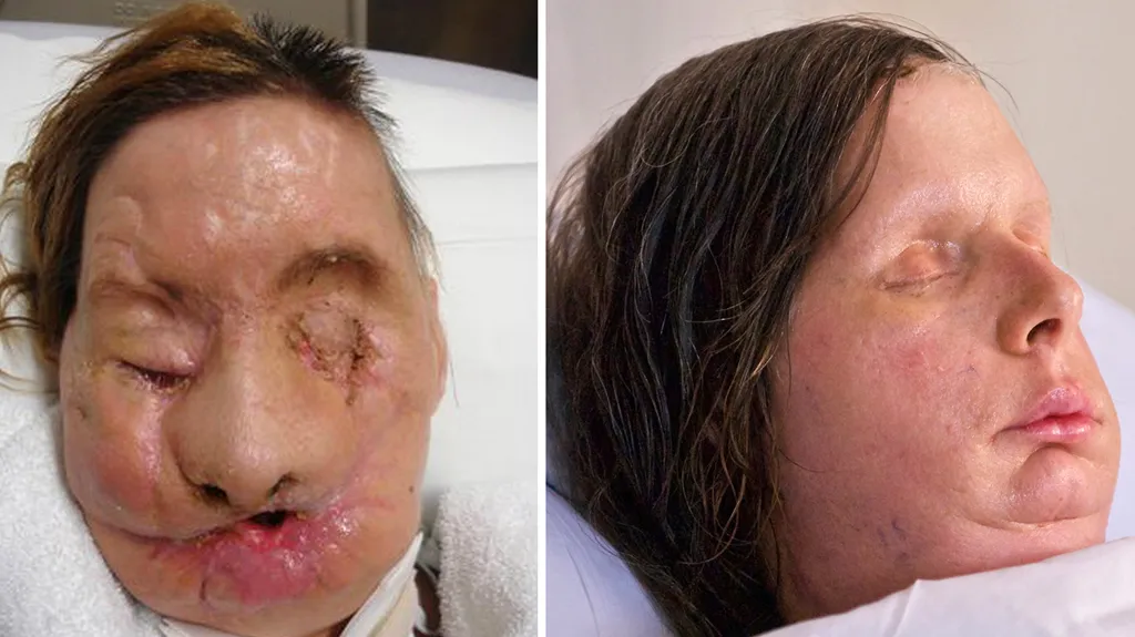 Charla Nashová před transplantací obličeje a po ní
