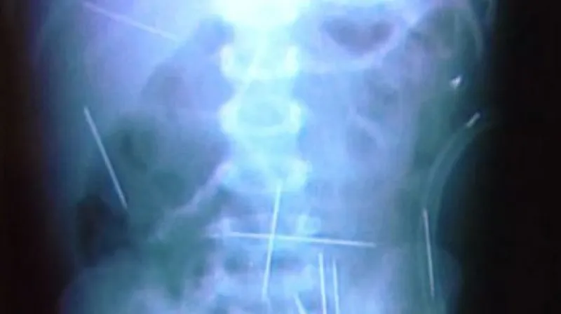Příběh propíchaného dítěte bude mít šťastný konec