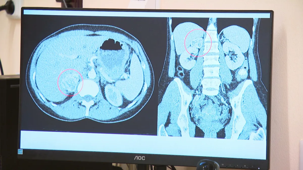 ▷ Záchyt nádorů nadledvin roste. Máme moderní metody, říkají lékaři — ČT24  — Česká televize