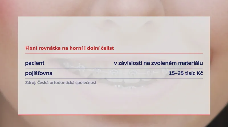 Fixní rovnátka na horní i dolní čelist
