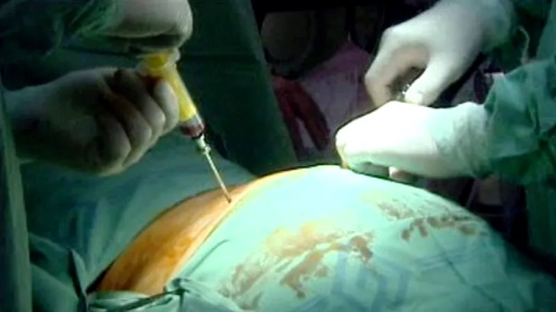 Transplantace kostní dřeně