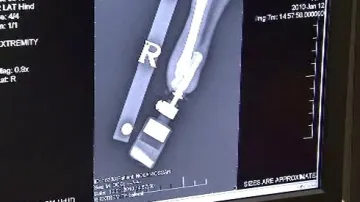 Snímek Oscarovy protézy