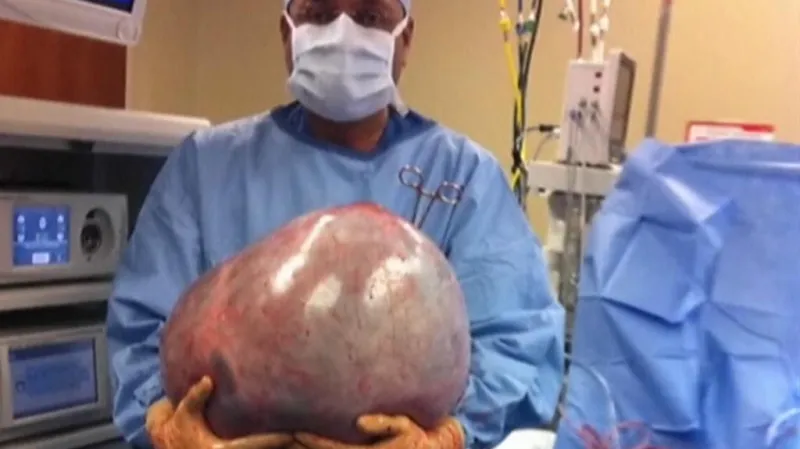Obří nádor na vaječníku