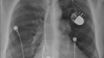 Kardiostimulátor na rentgenu
