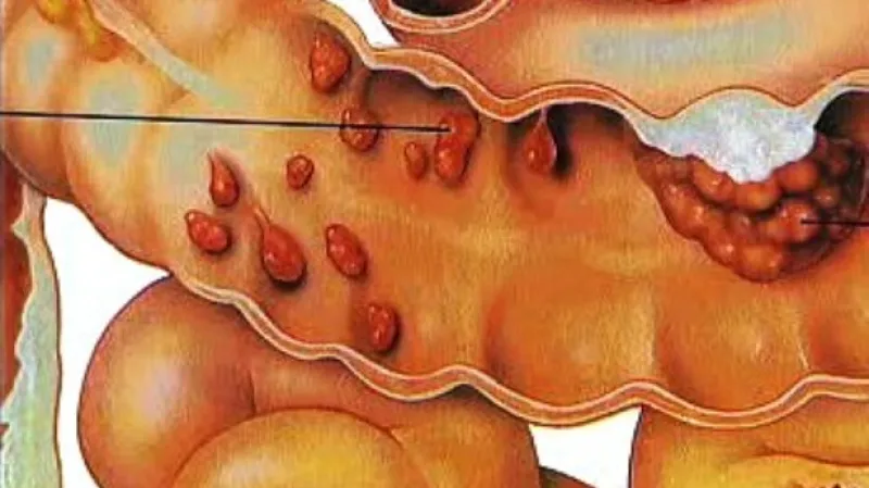 Polypy v tlustém střevě