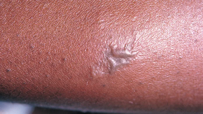 Léze na kůži jsou častým příznakem kapavky