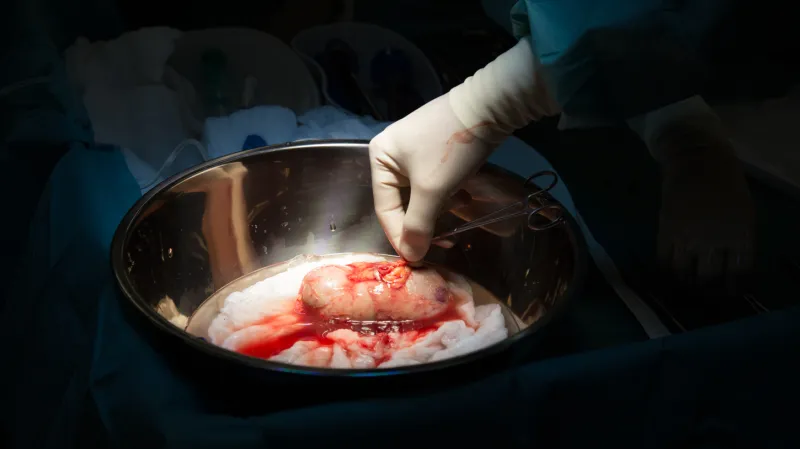 Ledvina určená k převozu a transplantaci