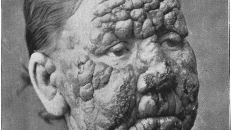 Ukázka projevů lepry