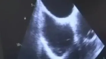 Lékaři FN Brno pomáhají lidem ohroženým cévní mozkovou příhodou