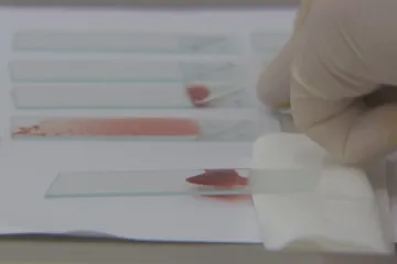 Proti leukémii se v Česku zkouší využití geneticky upravených bílých krvinek pacienta