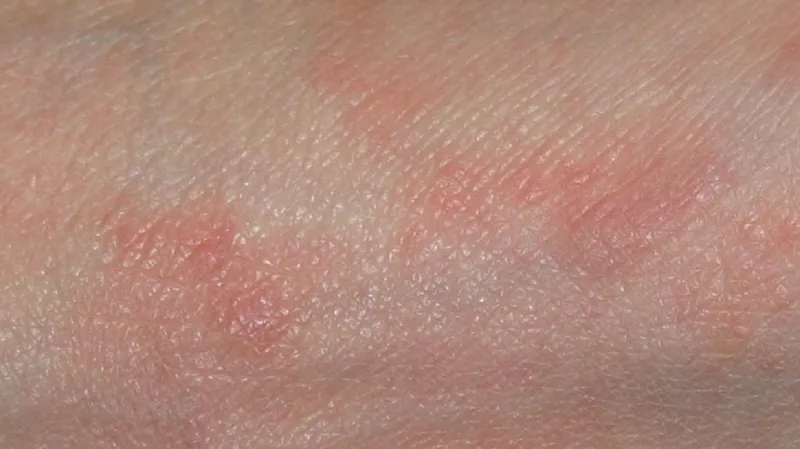 Projevy svrabu se často pletou s kopřivkou