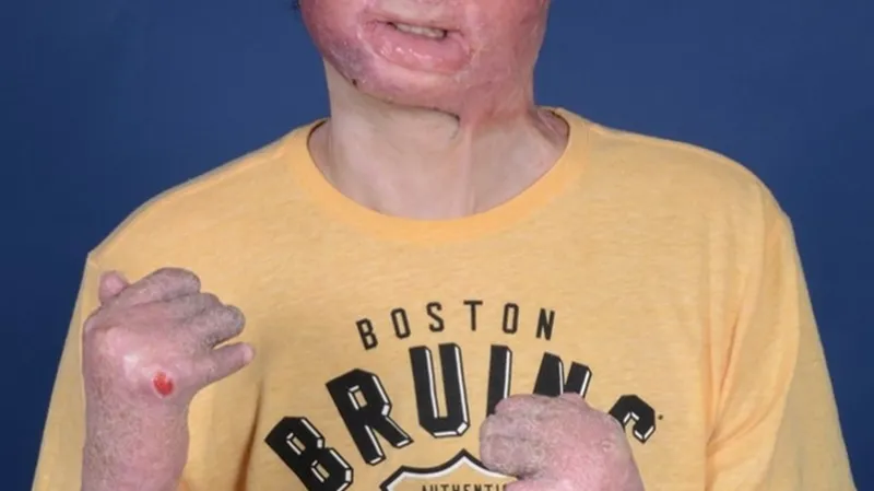 Joe DiMeo před transplantací