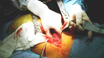 Transplantace ledvin