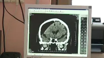 Scan mozku