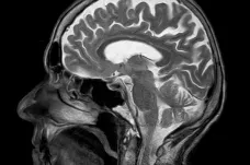 Mozky pacientů s covidem mohou být náchylné k poškození cév, uvádí studie z USA