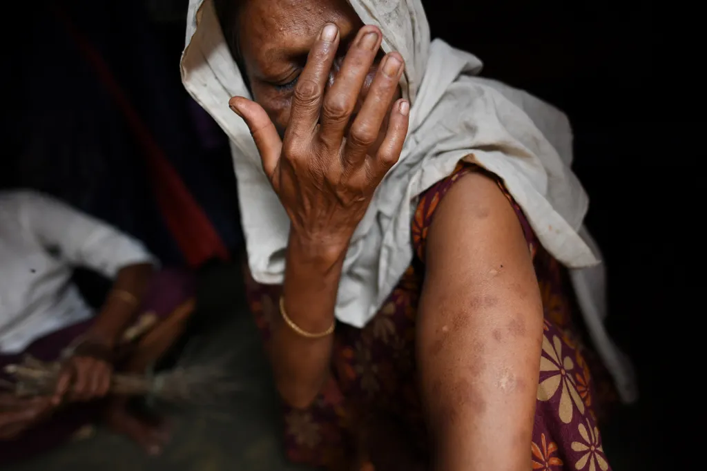 Rohingská uprchlice ukazuje v utečeneckém táboře v bangladéšském městě Cox's Bazar zranění po kulkách a šrapnelu, které utržila od armády Myanmaru při svém pokusu o útěk ze země v září 2017