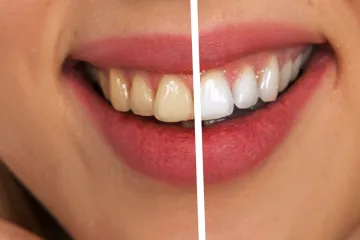 Plná pusa robotů. Vědci přišli na to, jak mohou odstranit plak ze zubů