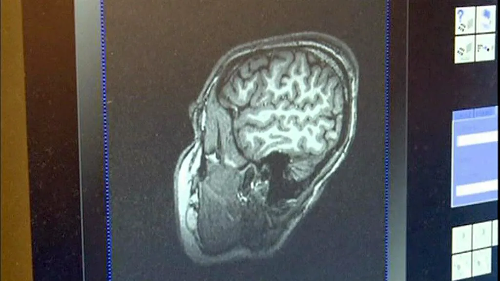 Vyšetření mozku