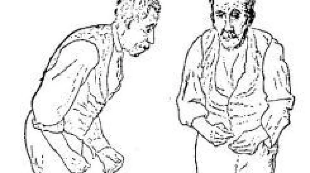 Ilustrace Parkinsonovy choroby