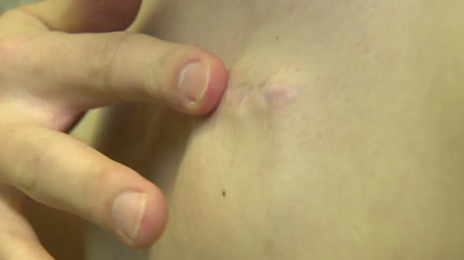 Pacient ukazuje jizvu po implantaci přístroje