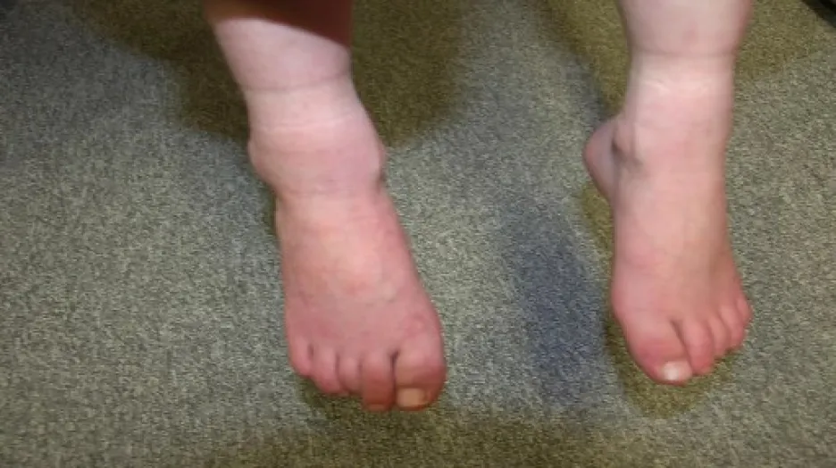 Týraný chlapec musel v botách nosit hřebíky