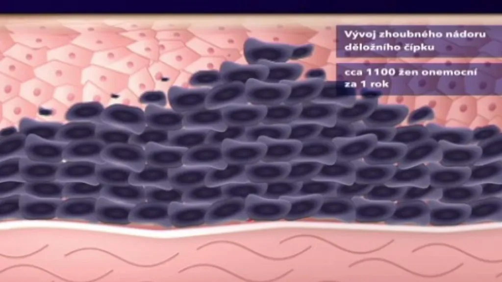 Rakovina děložního čípku