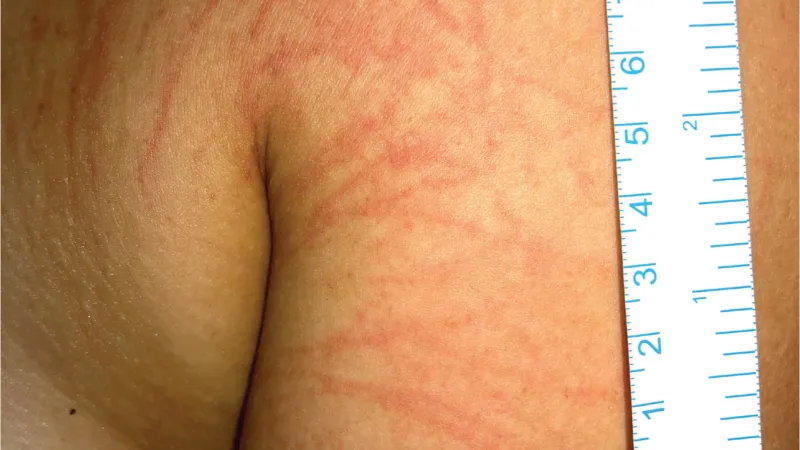 Stopy po chapadlech talířovky na kůži skotské plavkyně