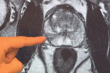 Prožití rakoviny je nepopsatelné. Posílí vás to, říká muž, který se vyléčil dvakrát