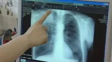 Nález pacienta s tuberkulózou