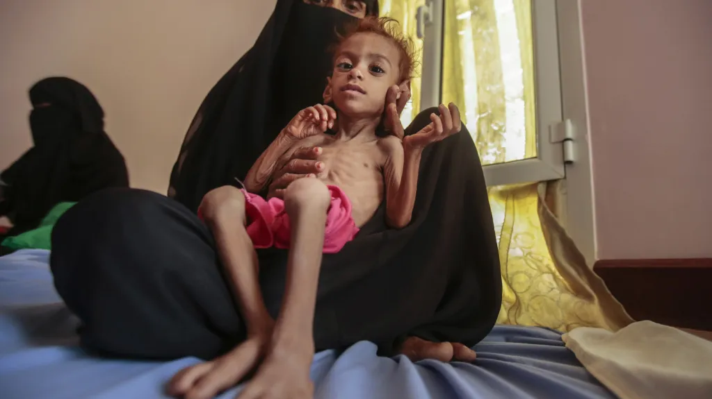 Žena drží v náručí podvyživené dítě v Jemenu