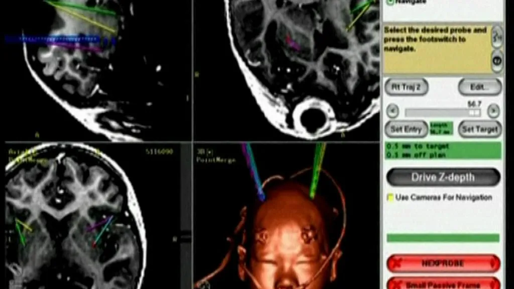 Léčba syndromu AADC pomocí genové terapie