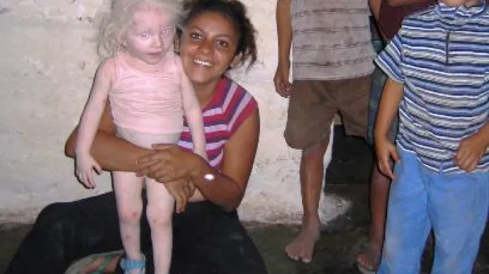 Albínské děvčatko v Hondurasu
