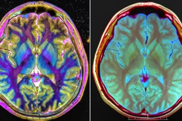 Lidé s psychózou mohou trpět jinými nemocemi, ukázala rozsáhlá studie