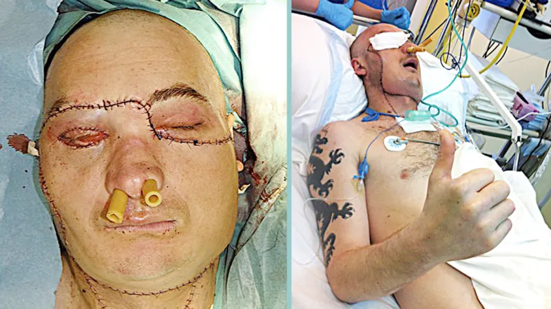 Muž, kterému v Polsku transplantovali obličej