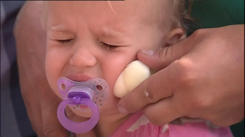 Dítě poštípané vosou