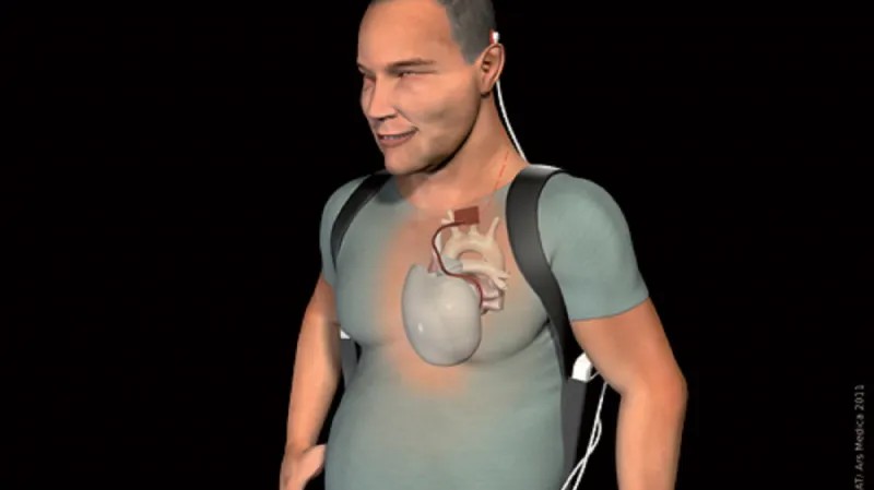 Umělé srdce CARMAT