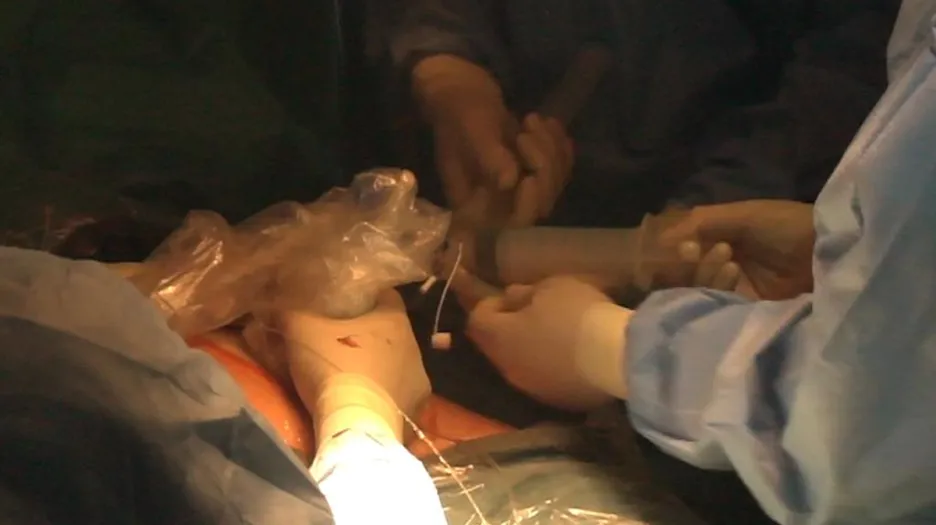 Operace plodu v těle matky