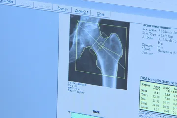 Česko zaostává v prevenci nemoci kostí. Lékaři chtějí situaci zlepšit díky plošnému screeningu osteoporózy 