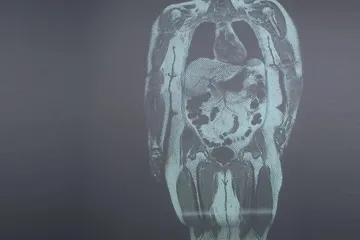 Extrémní obezitou v Česku trpí 150 tisíc lidí. Vznikají specializované ambulance