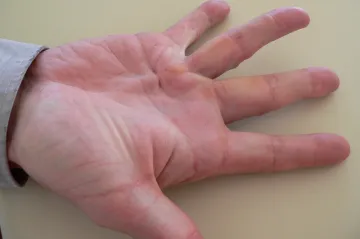  Genetikové rozluštili původ „vikinské nemoci“, sahá až k neandertálcům