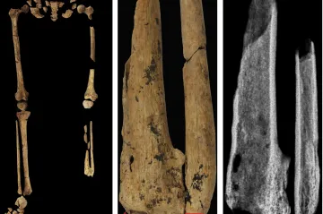 Poprvé se operovalo před 31 tisíci lety. Byla to amputace, zjistili archeologové