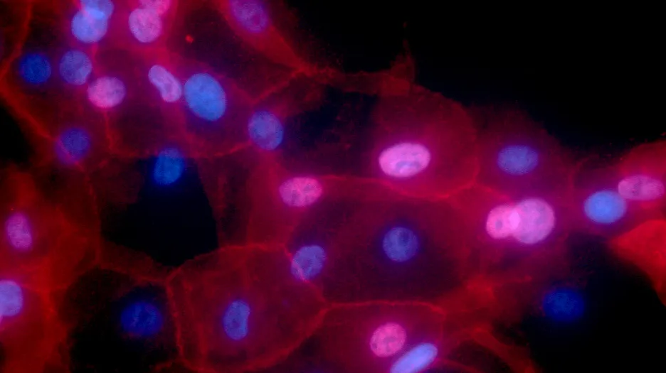 Buňky rakoviny prsu