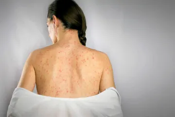 Spalničkami onemocnělo už 530 lidí. Očkovat se opět mohou i dospělí