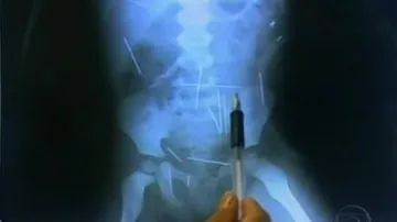 Rentgenový snímek jehel v těle