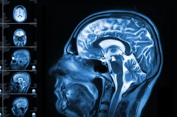 Další roky života v klidu slibuje nový genový lék na Huntingtonovu chorobu