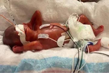 Chlapec přišel na svět ve 21. týdnu. Je nejpředčasněji narozeným dítětem, které přežilo