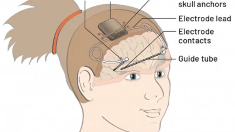 Schéma implantátu Picostim