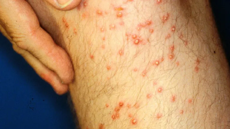 Pokousání ohnivým mravencem